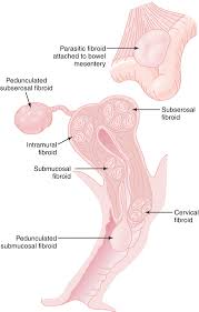 Image result for Friable Cervix