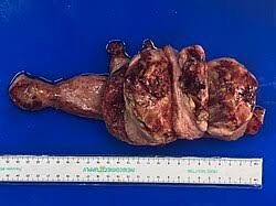 Image result for Leiomyosarcoma