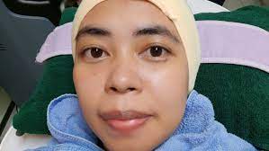 Pantangannya gak boleh kena sinar matahari dan cuci mukanya pake air mineral buat minum, bukan. Buang Tahi Lalat Hidup Dan Bulu Halus Di Bahagian Muka Guna Kaedah Laser Di Toscana Mediclinic Qisstiera
