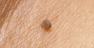 So dont get carried away.!! The Key Benefits Of Skin Tag Removal Dermatology And Skincare Associates