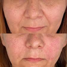 Dra. Taline Rodrigues | Harmonização/ Master Injector | Preenchimento de bigode  chinês - Legenda: Foto 1 : Antes e depois pós imediato/ Foto 2: resultado  após 20 dias. Os resultados serão ainda... | Instagram