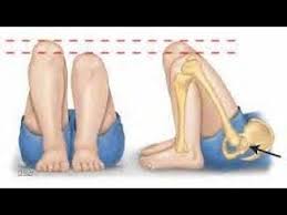 Image result for Galeazzi Sign