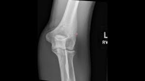 Image result for Coronoid Process Fracture