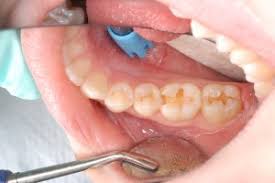 How long does it take to get 2 cavities filled. Tooth Filling Cost Auckland Nz Dental Fillings In Epsom