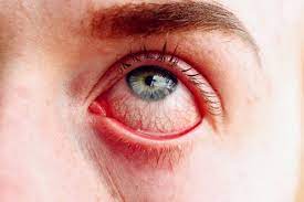 Maybe you would like to learn more about one of these? Coronavirus Symptoms Ireland 4 Mild Covid 19 Symptoms You Shouldn T Ignore Including Eye Infection And Fog Irish Mirror Online
