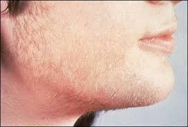 The above products are designed to deliver highly researched and developed formulas that will deliver positive hair growth results time and time again. Hirsutism Wortix