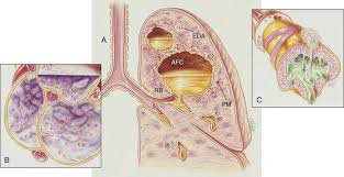 Image result for Lung Abscess