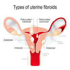 (less than 1 cm to 5 cm): Fibroids St Louis Mo Farmington Mo Midwest Institute For Non Surgical Therapy