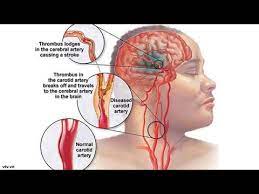 Find investment information and connect with cara menyembuhkan stroke sebelah kiri dengan cepat , a tasikmalaya, west java, indonesia based healthcare services startup. Cara Merawat Stroke Sebelah Kanan Cara Menyembuhkan Stroke Sebelah Kanan Secara Alami Youtube