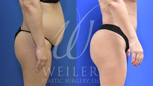 Brazilian Butt Lift Before and After Pictures Case 676 | Baton Rouge,  Louisiana | Weiler Plastic Surgery