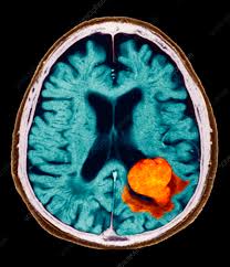 Image result for Brain Lesion