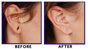 5 Questions People Ask Before An Earlobe Reconstruction Surgery Plastic Surgeon Beverly Hills California