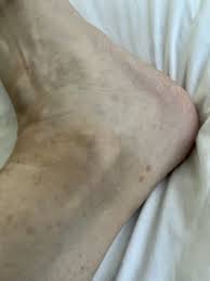 Image result for brown patches on the feet