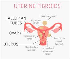 I know we'll get pregnant again soon. Fibroid Removal Surgery Laparoscopic Myomectomy In Bangalore