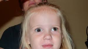 Eye muscle surgery is a surgery to correct strabismus (eye misalignment) or nystagmus (eye wiggling). Before And After Eye Muscle Surgery Photos Sarasota Bradenton Florida