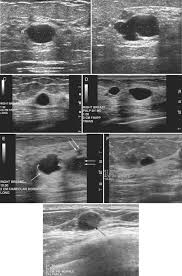 Ultrasound seems to be better than mammography for detecting invasive breast cancers and cancers without calcifications, a new study finds. Breast Ultrasound Clinical Gate