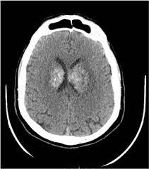 Cerebral venous thrombosis (cvt) or cerebral venous sinus thrombosis (cvst): A Case Of Selective Straight Sinus Thrombosis Sst Sudden Onset And Evolution