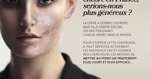 La lèpre existe toujours, les associations se mobilisent