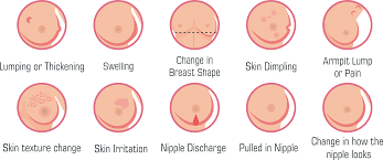 Dimpled skin is a common sign of inflammatory breast cancer, which draws its name from an inflamed appearance. What Does Skin Dimpling Look Like In Breast Cancer Breast Cancer Skin Dimpling Vector Icon Stock Vector Royalty Free 1844118067 Microcalcifications Which Look Like White Specks On A Mammogram