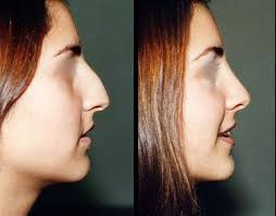 Tου Dr. med. Βασίλη Παυλιδέλη Χειρουργός ΩΡΛ • Eξειδικευμένος στη  Ρινοπλαστική