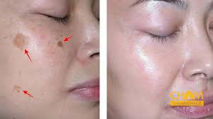 Nám chân sâu là gì? cách trị nám chân sâu dứt điểm