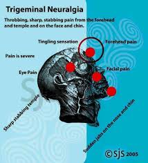 Trigeminal Nuealgia Cluster Headaches Headache Neuralgia