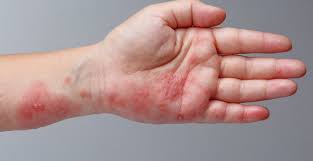 Image result for sweat rash on back