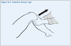 Image result for Knee Bulge Sign