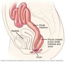 In right colon cancers the indicated operation is right hemicolectomy with primary ileotransverse anastomosis. Colectomy Mayo Clinic