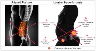 A strained muscle in your lower back can be quite painful. What Is Lower Cross Syndrome Dr Tri Myers In Cary Nc