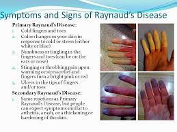 Raynaud S Disease Afshine Ash Emrani Md Facc Cardiologist