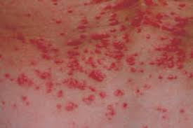 Image result for scabies in the groin area