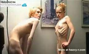 Anorexic Girls Posing Nude - HD Porn Videos, Sex Movies, Porn Tube
