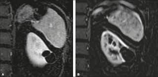 Progression Rate In Bosniak Category Iif Complex Renal Cysts