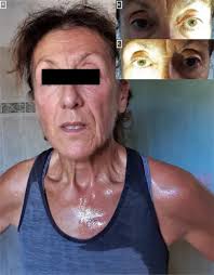 Image result for Anhidrosis