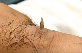 Image result for cornu cutaneum)