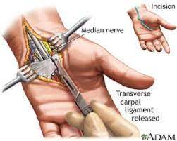 Cpt Code 64721 Coding Tips For Carpal Tunnel Release Medical Coding Guide