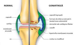 În cazul paraliziei totale ale sciaticului are loc o paralizie completă a tuturor mişcărilor gleznei şi degetelor şi o pareză sau o paralizie a flexorilor gambei. 8 Afectiuni Care Favorizeaza Criza De Sciatica Sau Inflamarea Nervului Sciatic Dureri Articulare È™i Nerv Sciatic