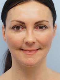 Mini Lift, Laser Resurfacing, Facial Filler* 1606