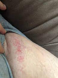 Woke Up With Itchy Rash On Inner Thigh Any Ideas Dermatology