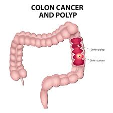 Inheritance of this type of cancer is autosomal dominant, which means that half the children of someone with hnpcc are at risk of inheriting the condition. Familial Adenomatous Polyposis Medlineplus Genetics