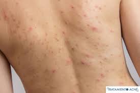 Tratamiento Del Acne De La Espalda Y Del Cuerpo Acne Corporal