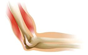 Image result for Epicondyle Injection