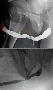 Image result for Retrograde Urethrogram