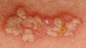 But it's totally possible for both types of herpes simplex to infect either area. Difference Between Hsv 1 And Hsv 2 Youtube