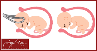 Image result for Forceps Assisted Delivery