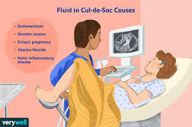 Fluid In Cul-De-Sac And Midline Displacement Of Bilateral Ovarian... |  Download Scientific Diagram