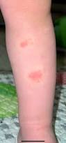 Image result for shingles in children