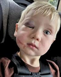 Day care worker arrested for child abuse as toddler left with black eye and  swollen face