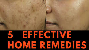 5 Effective Home Remedies For Skin Pigmentation Brown Spots And Freckles Youtube 5 effective home remedies for skin pigmentation brown spots and freckles